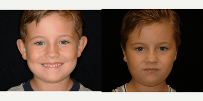 Case 11058 - 17 or under year old man treated with Ear Surgery
