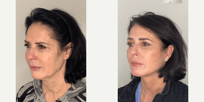 Case 11171 - 55-64 year old woman treated with Facelift, Neck Lift, Eyelid Surgery, Facial Fat Transfer, CO2 Laser