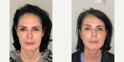 Case 11172 - 55-64 year old woman treated with Facelift, Neck Lift, Eyelid Surgery, Facial Fat Transfer, CO2 Laser