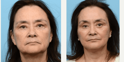 Case 11173 - 55-64 year old woman treated with CO2 Laser