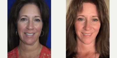 Case 11174 - 55-64 year old woman treated with Neck Lift, Facelift, CO2 Laser