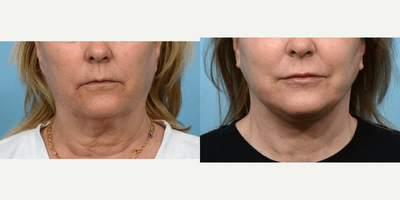 Case 11176 - 55-64 year old woman treated with CO2 Laser