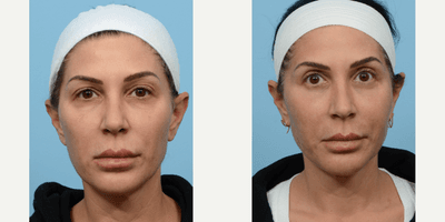 Case 11177 - 45-54 year old woman treated with Eyelid Surgery, Double Eyelid Surgery, Facial Fat Transfer, CO2 Laser