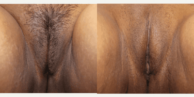 Case 11178 - Woman treated with CO2 Laser