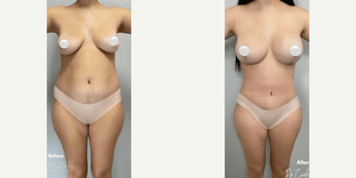 Case 11375 - Woman treated with Mommy Makeover