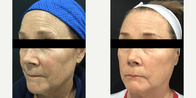 Case 11488 - 55-64 year old woman treated with VI Peel and Morpheus8