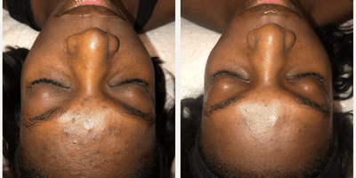 Case 11489 - Woman treated with VI Peel
