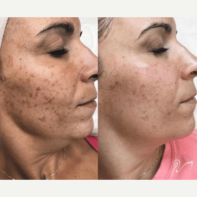 Case 11490 - 25-34 year old woman treated with VI Peel