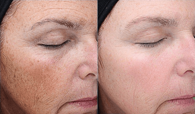 Case 11492 - VI Peel