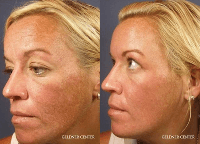 Case 11493 - Woman treated with VI Peel