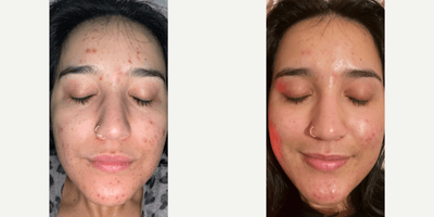 Case 11494 - 25-34 year old woman treated with VI Peel Purify