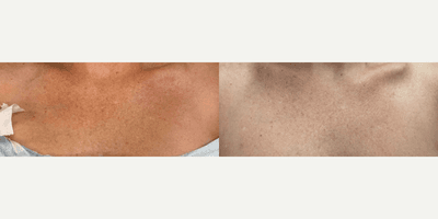 Case 11495 - Woman treated with VI Peel