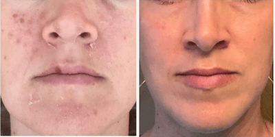 Case 11496 - 35-44 year old woman treated with VI Peel and Aerolase Neo