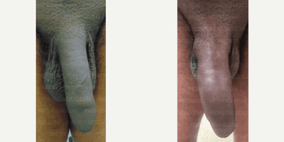 Case 11513 - Man treated with Penis Fillers, Penis Enlargement