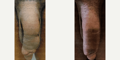 Case 11515 - Man treated with Penis Fillers, Penis Enlargement