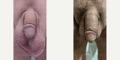Case 11518 - Woman treated with Penis Enlargement