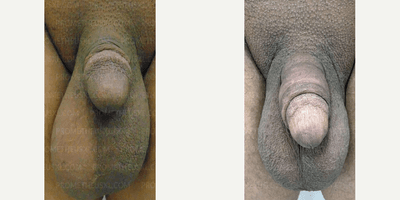 Case 11519 - Woman treated with Penis Enlargement