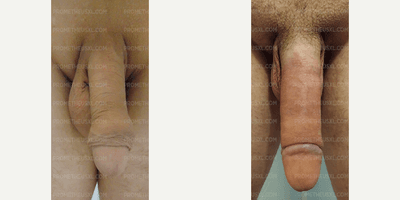 Case 11520 - Woman treated with Penis Enlargement
