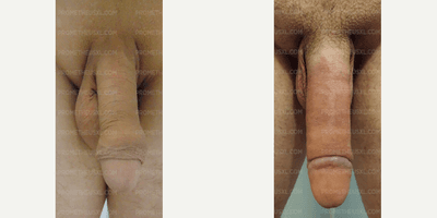 Case 11521 - Woman treated with Penis Enlargement