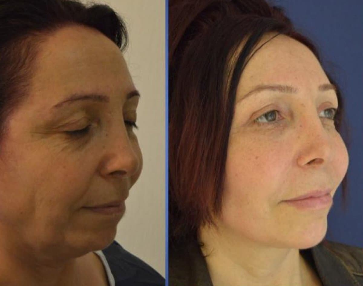 Facelift Surgery (Rhytidectomy) — Transformative Results