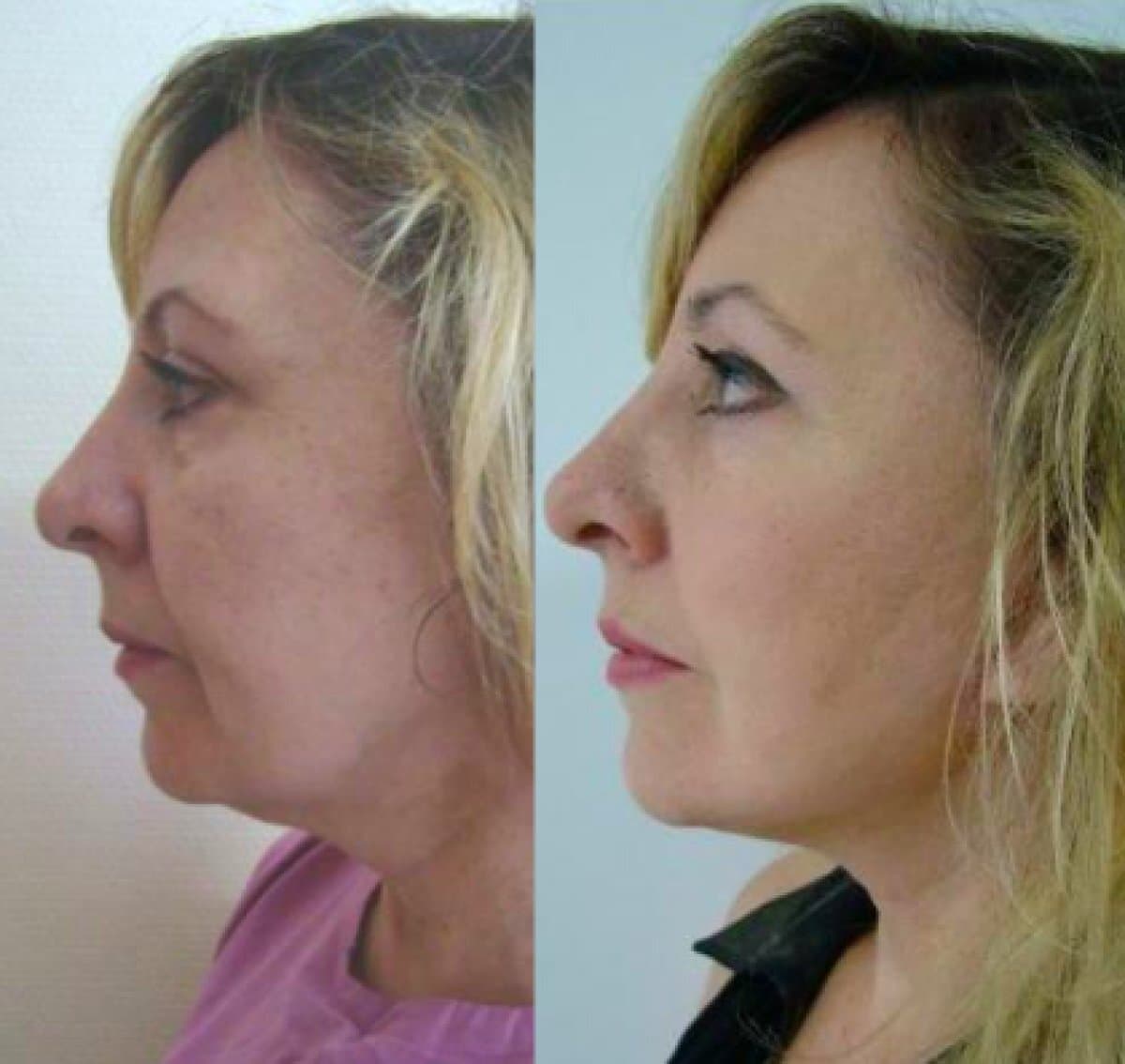 Facelift Surgery (Rhytidectomy) — Transformative Results