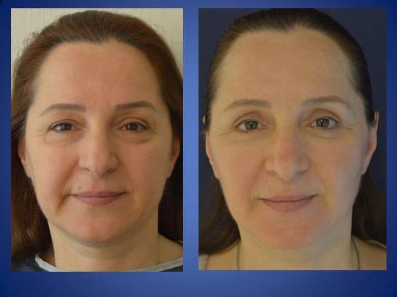 Facelift Surgery (Rhytidectomy) — Transformative Results