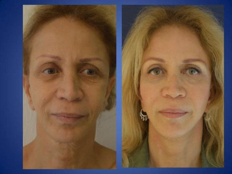 Facelift Surgery (Rhytidectomy) — Transformative Results