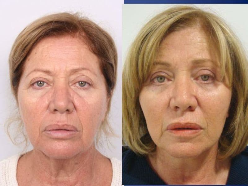 Facelift Surgery (Rhytidectomy) — Transformative Results