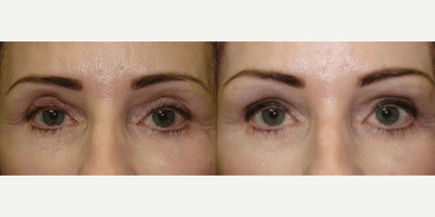 Restylane