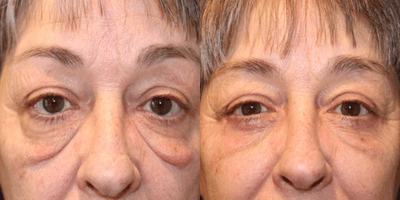 Eyelid Surgery