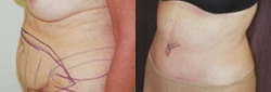 Liposuction