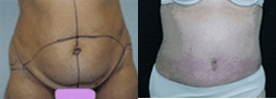 Tummy Tuck