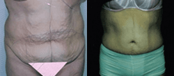 Panniculectomy