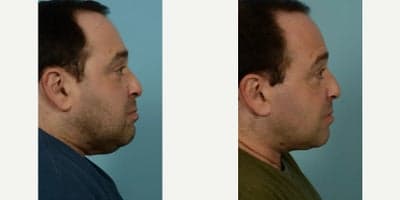 Neck Lift