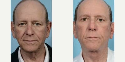 Eyelid Surgery