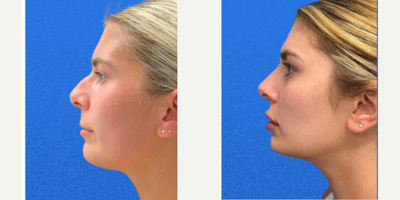 Dermal Fillers