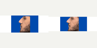 Restylane
