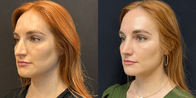 Rhinoplasty