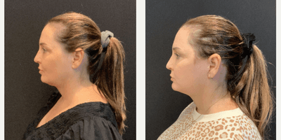 Facelift