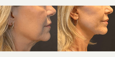 Neck Lift
