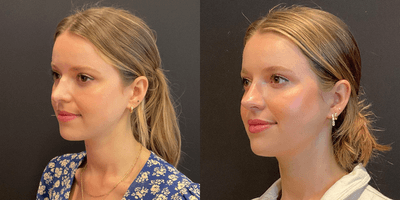 Revision Rhinoplasty