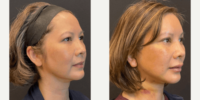 Eyelid Surgery