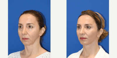 Deep Plane Facelift