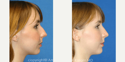 Rhinoplasty