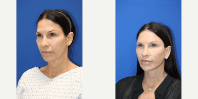 Facelift