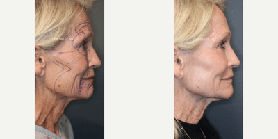 Laser Resurfacing