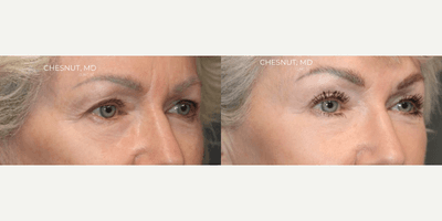 Brow Lift