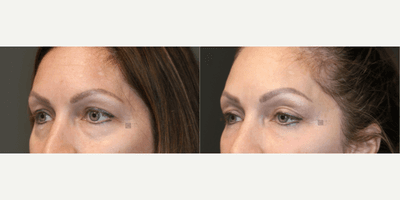 Juvederm