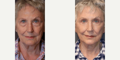 Fractional Laser