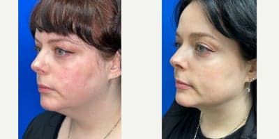 Liposuction